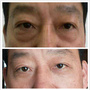 非手术专利除眼袋