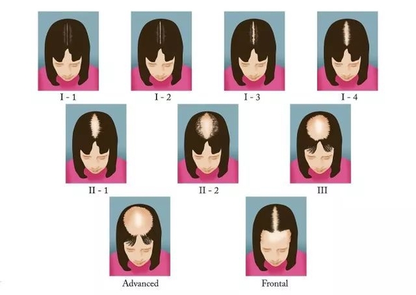 女性脱发的模式一般是从头顶开始