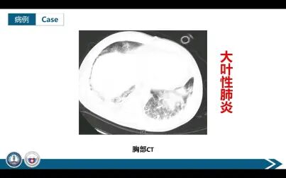 [图]简单易学的医学影像学——大叶性肺炎