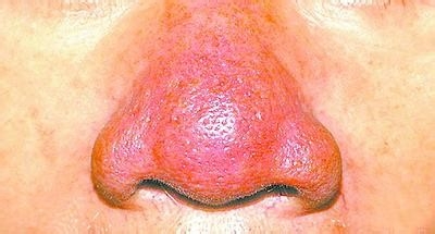 常见于40岁后的男性,鼻部结缔组织增生,皮脂腺异常增大使鼻子变大