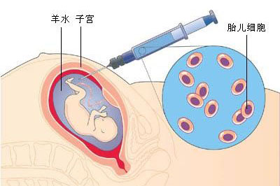 1,具有适应症的准妈妈先做b超,确定胎盘位置,胎儿情况,避免误伤胎盘;2