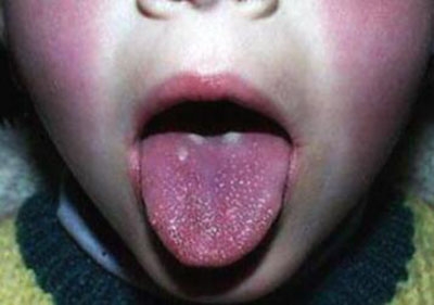 "杨梅样舌" "口周苍白区"猩红热其他特征:猩红热患儿还可出现口周