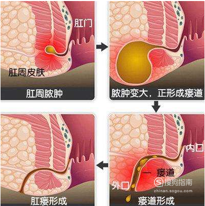 及时治疗肛隐窝炎,禁忌腐烂后致使溃疡及皮下瘘,溃疡性大肠炎等