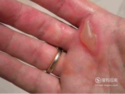 炒菜被油烫伤怎么办如何有效防止油溅到手上