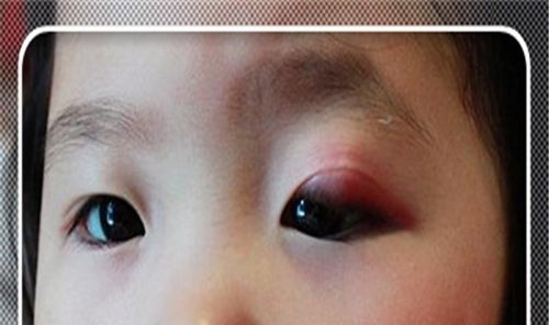 眼皮上的麦粒肿俗称针眼.刚初起时眼皮有瘙痒,微痛,红肿.