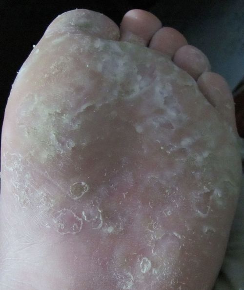 08 湿菌型,此类多发于年轻患者当中常伴有足部汗湿现象,患者冬季多会