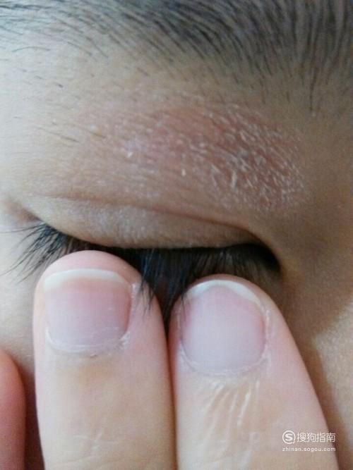 眼皮过敏痒起皮怎么办?这几天有点肿?