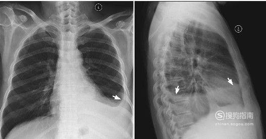 气胸和液气胸:多见于自发性气胸或外伤穿透胸膜所致气胸,液气胸.