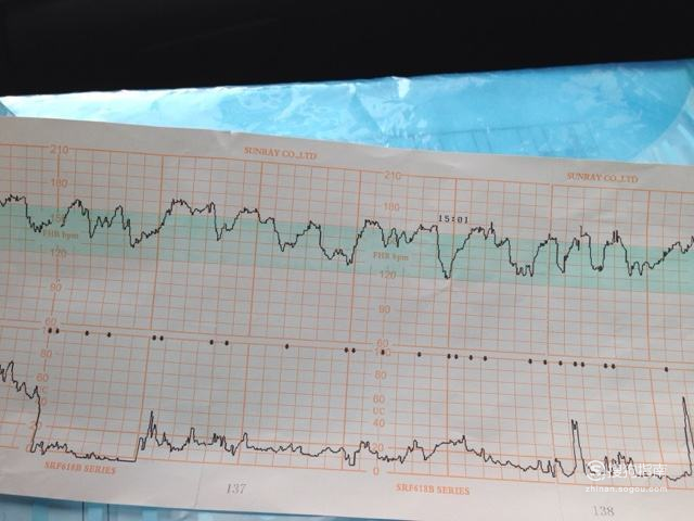 怎么看胎心监护图?