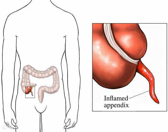 阑尾位置是怎样的?不是男左女右吗?