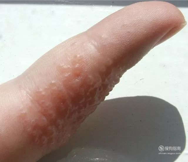 手指上有水泡医生说是汗疱疹怎么治