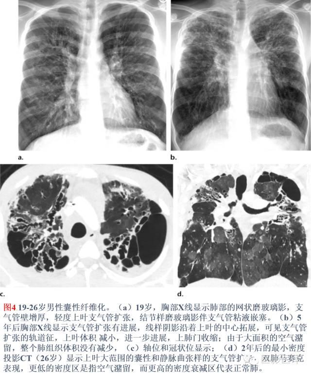 支气管扩张的机制,影像特征和病因