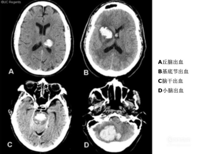 教你看头颅ct片