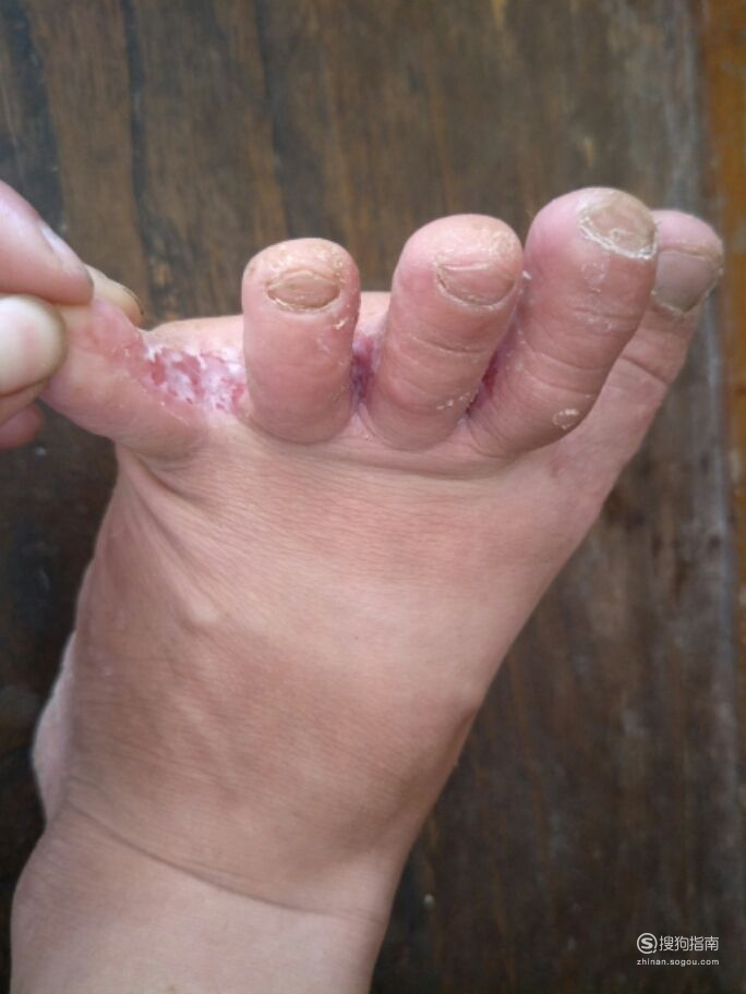 常见脚趾缝,起初表现为脚部皮肤浸白,通过走路或鞋袜的摩擦形成糜烂