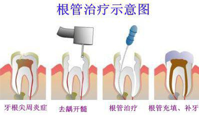 牙齿根管治疗的步骤是怎样的