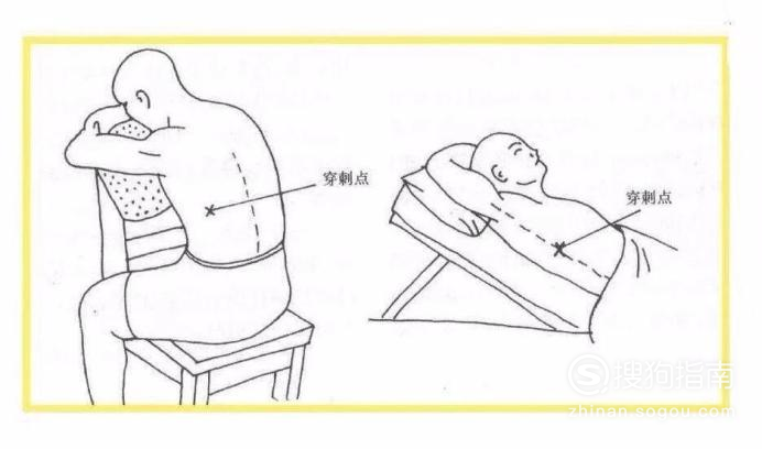 胸腔穿刺操作步骤