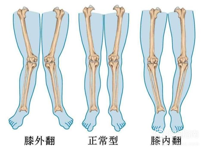 如何判断小孩o型腿及治疗方法