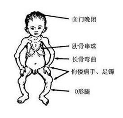 婴儿佝偻病早期症状图片 婴儿佝偻病早期症状