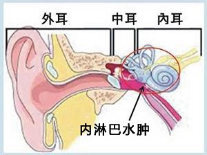 美尼尔氏综合症病因