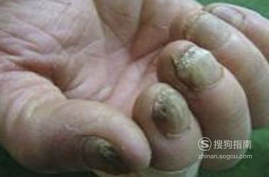 灰指甲病因是什么 灰指甲的病因都有哪些？