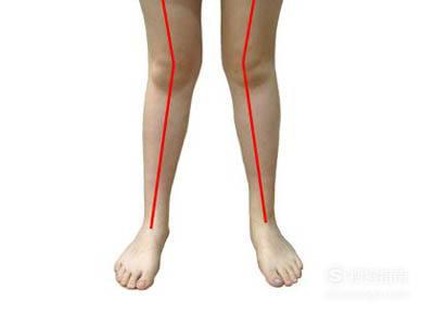 x型腿矫正的方法 什么是x型腿？x型腿怎么矫正？