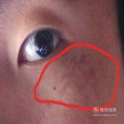 眼角下长斑是什么原因引起的 眼角下长斑是什么原因？是什么原因造成的