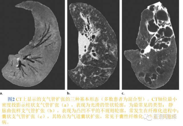 支气管扩张的机制影像特征和病因